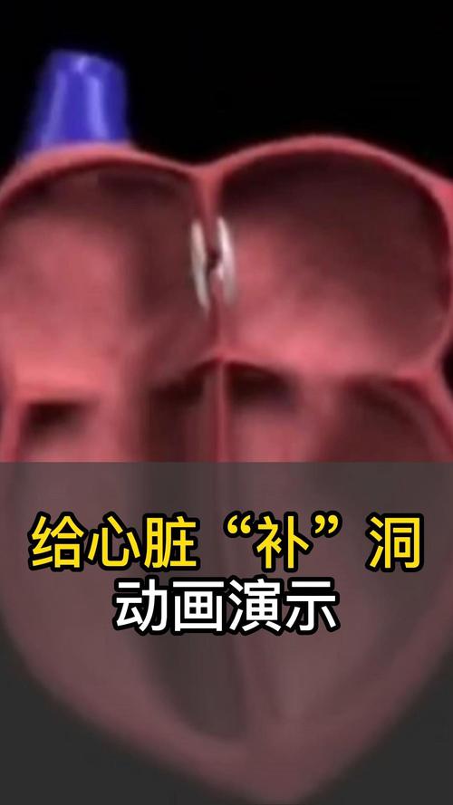 福建4岁男孩心脏上破5洞,孩子心脏有个洞怎么保守治疗